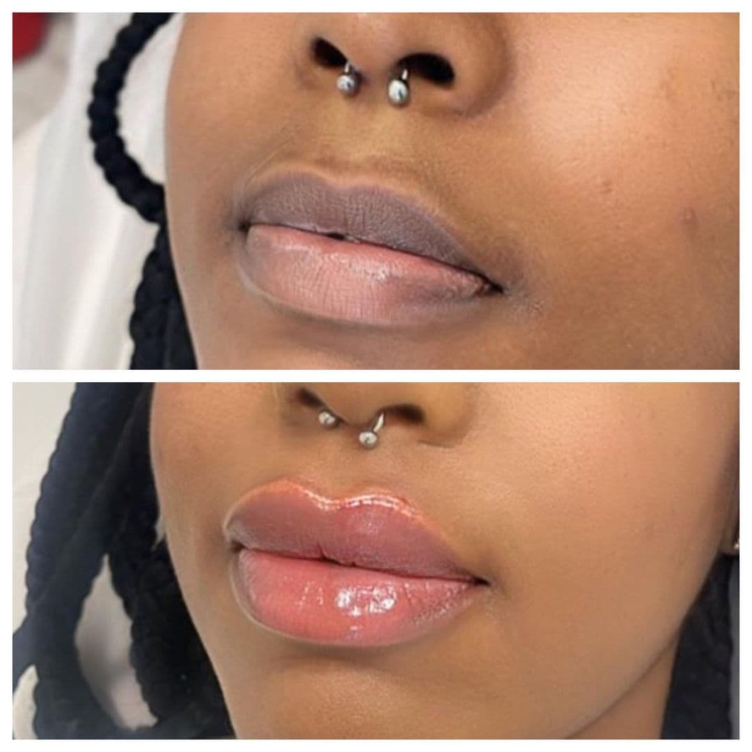 Russian Lip Fillers Vienna | Russian Lip Technique | Aura Medspa — photo 1