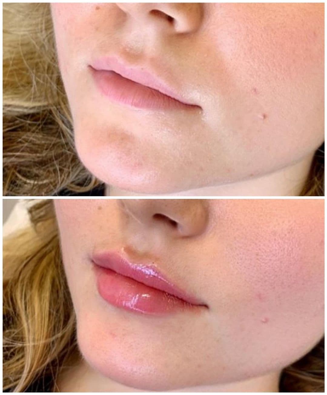 Russian Lip Fillers Vienna | Russian Lip Technique | Aura Medspa — photo 2