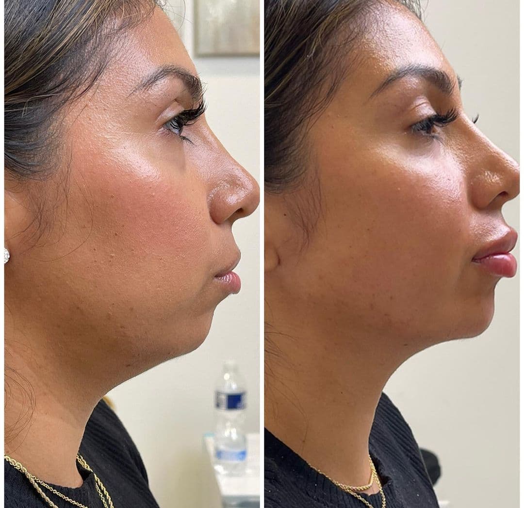 Liquid Full Face Transformation in Vienna, VA | Aura Medspa — photo 2
