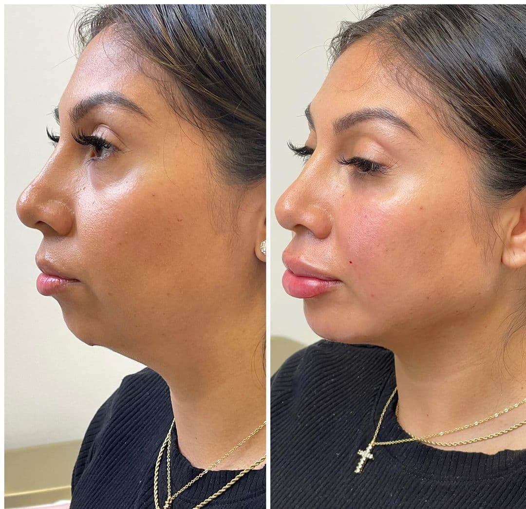 Liquid Full Face Transformation in Vienna, VA | Aura Medspa — photo 1