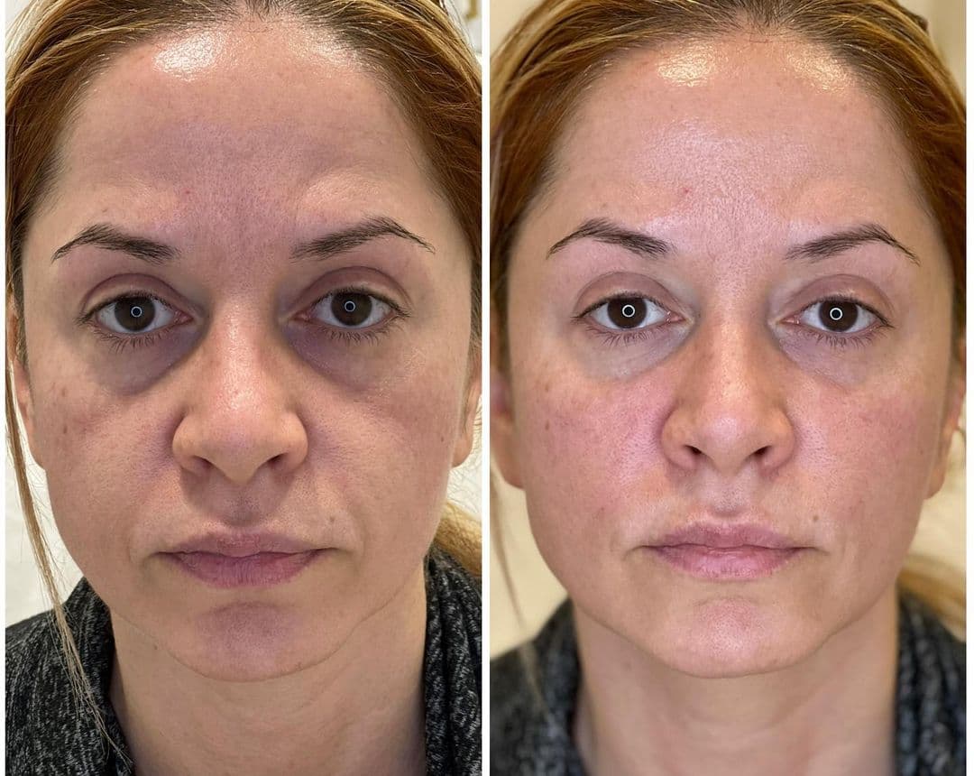 Cheek Filler | Aura Medspa — photo 1