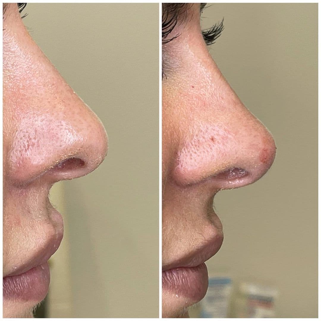 Liquid Nose Job in Vienna, VA | Aura Medspa — photo 1