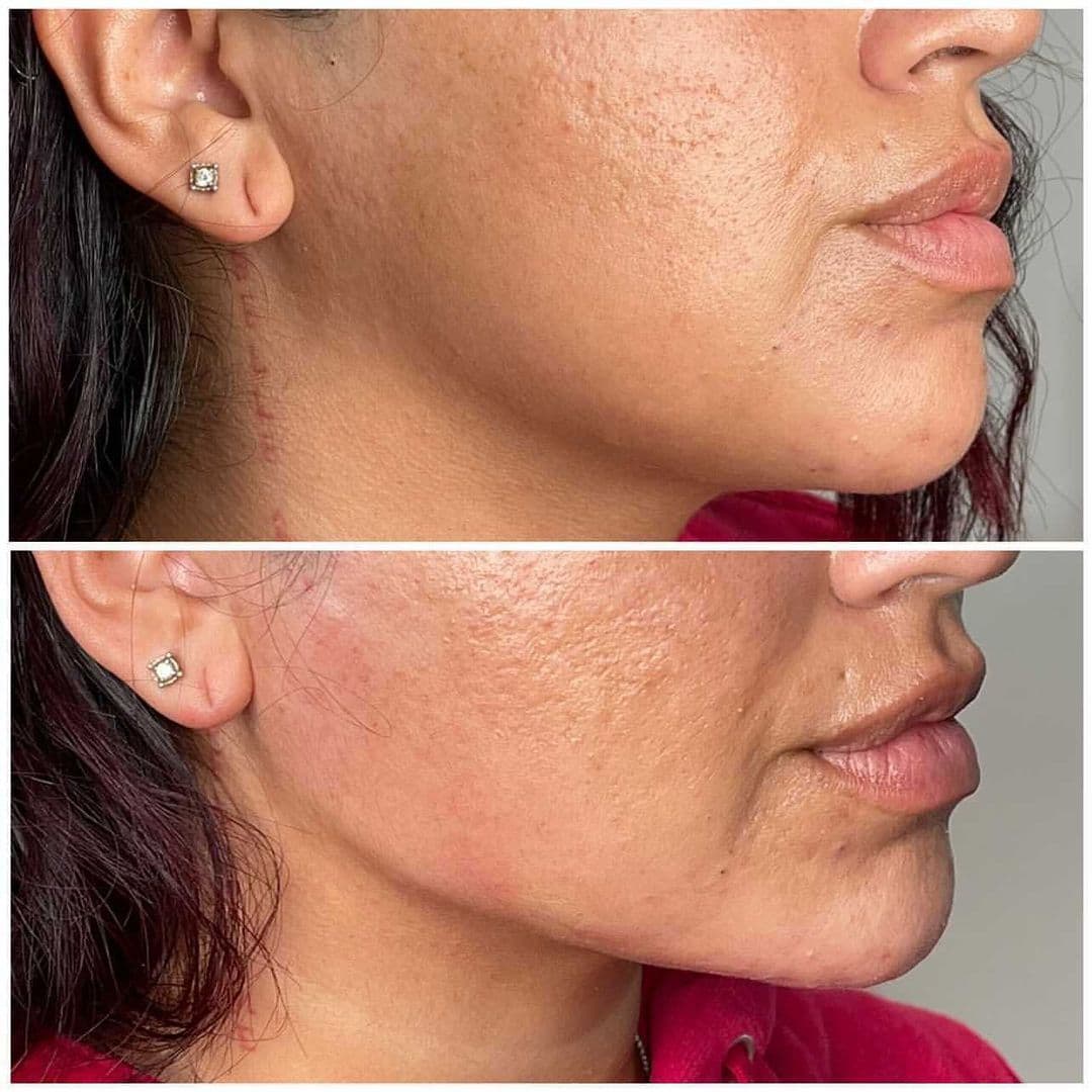 Jawline | Aura Medspa — photo 2
