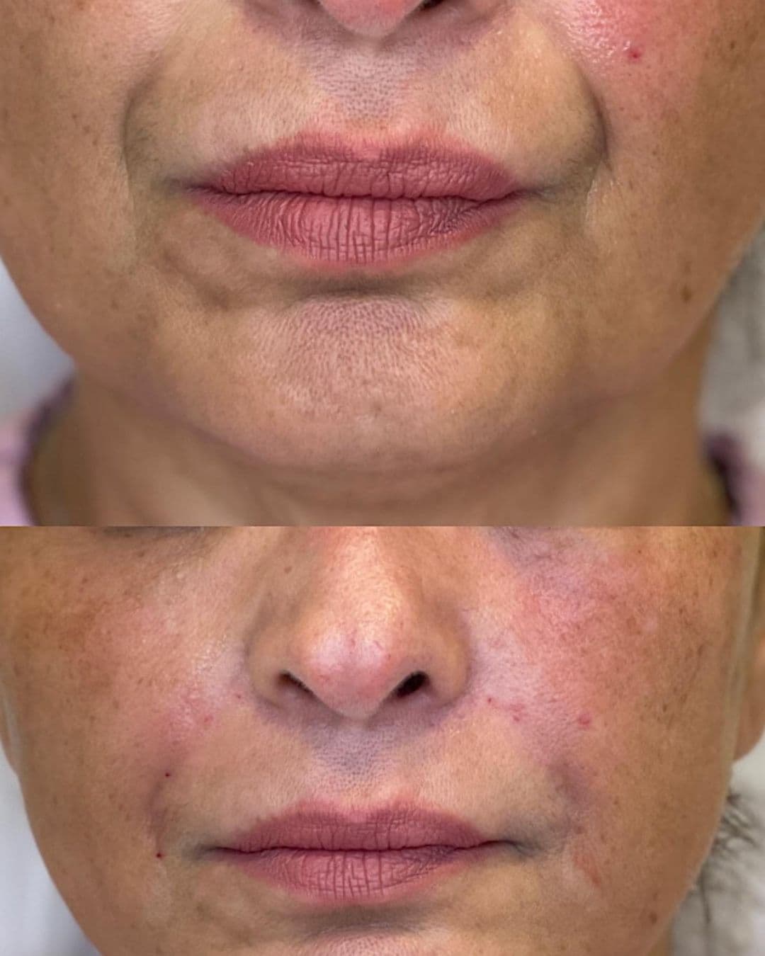 Smile Lines | Aura Medspa — photo 1