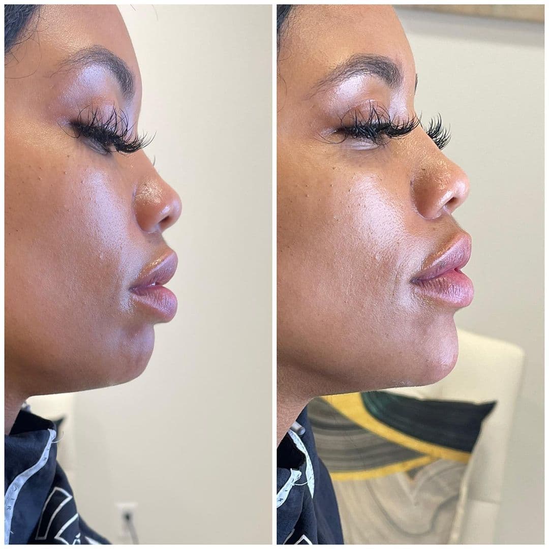 Chin Filler | Aura Medspa — photo 1