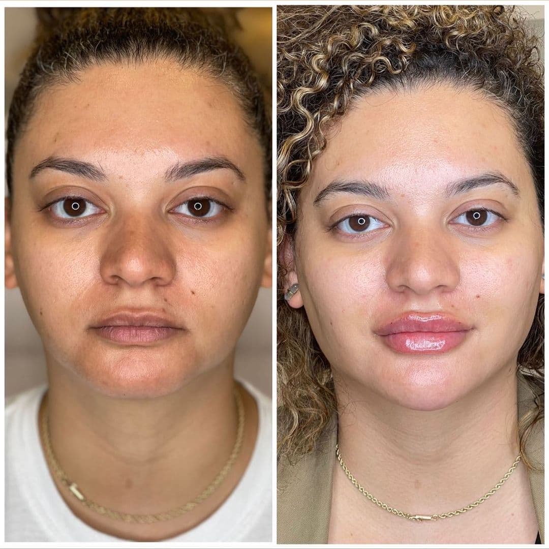 Chin Filler | Aura Medspa — photo 2