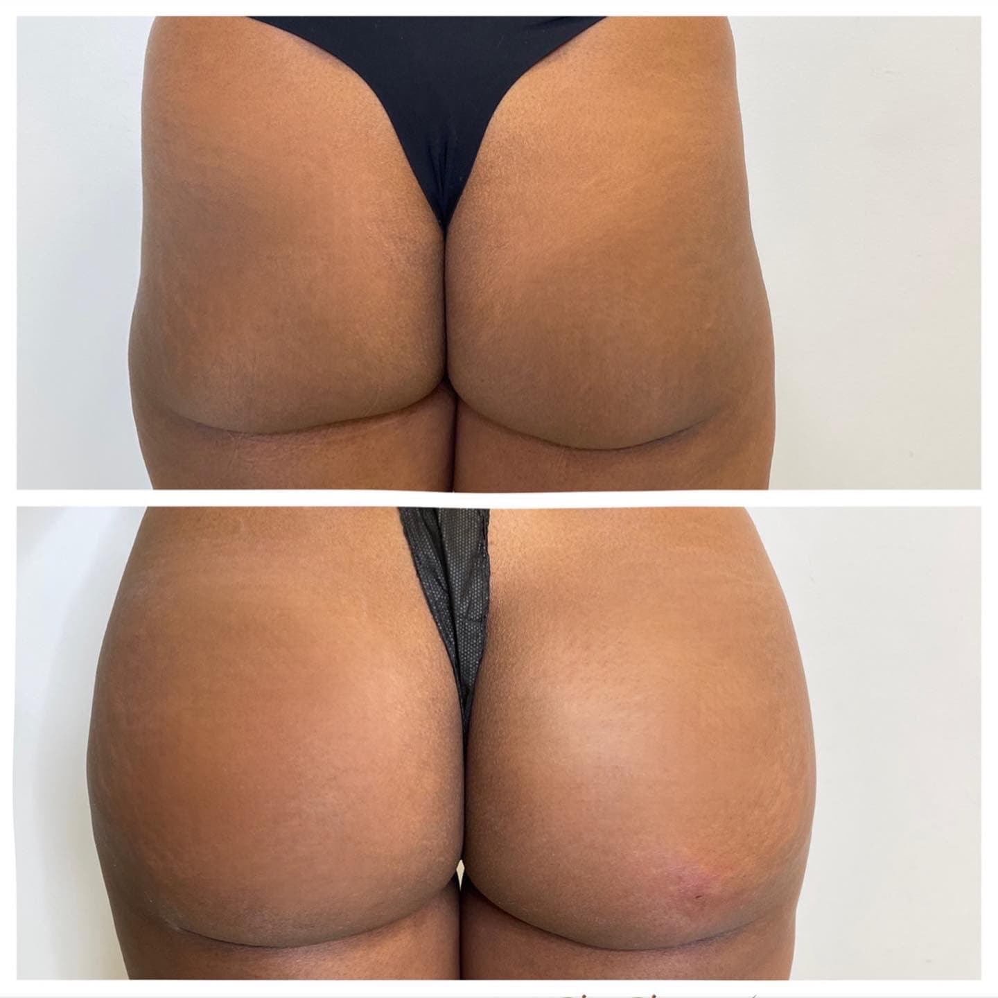 Non-Surgical BBL in Vienna | Brazilian Butt Lift | Aura Medspa — photo 1
