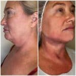 Tumescent Lipo Reduction in Vienna | Aura Medspa — photo 2