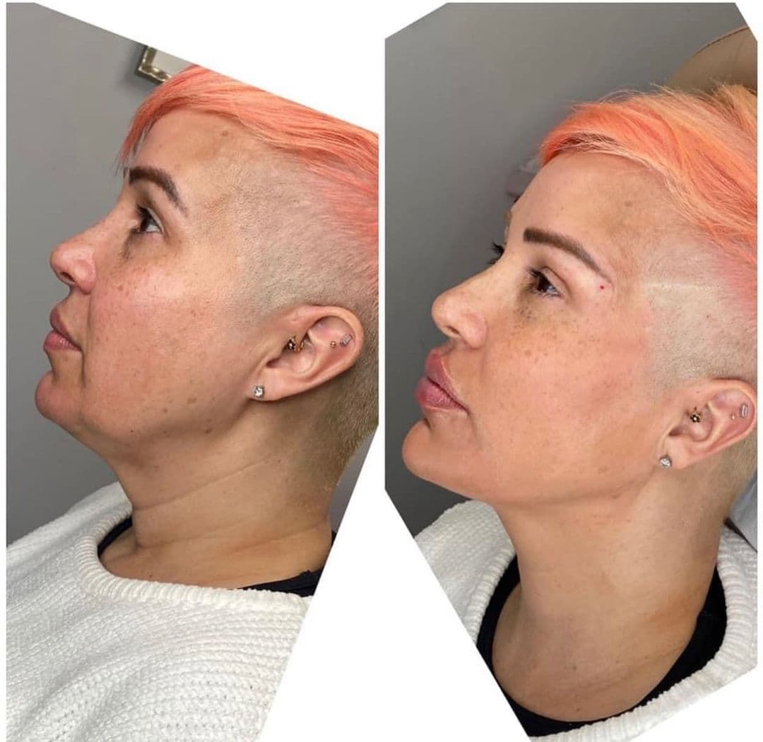 Full Face Transformation in Vienna, VA | Aura Medspa — photo 1