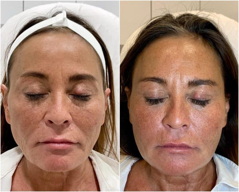 Sculptra Injectables Vienna | Sculptra | Aura Medspa — photo 1