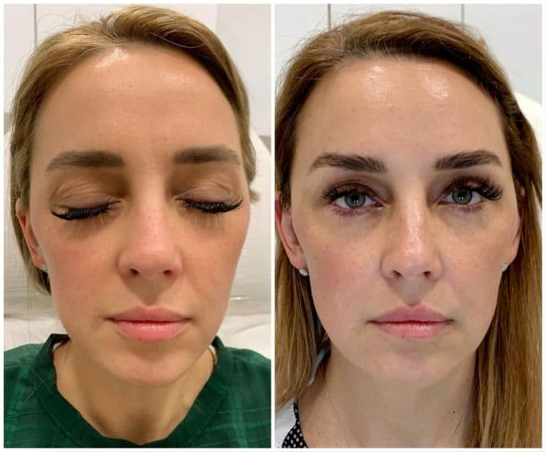 Sculptra Injectables Vienna | Sculptra | Aura Medspa — photo 2