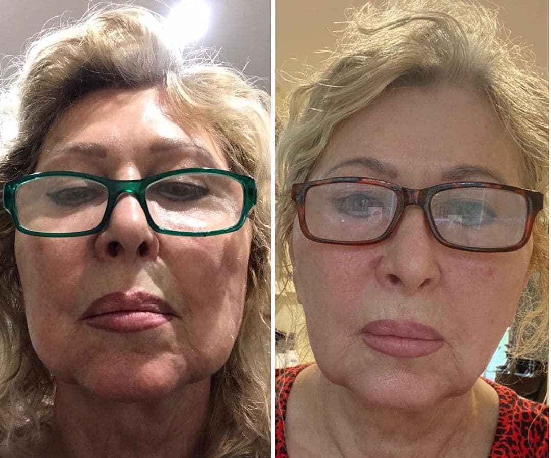 Fat Dissolving Injections | Aura Medspa — photo 1