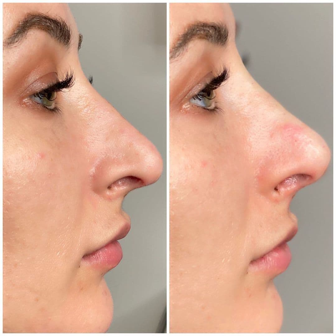 Non-Surgical Nosejob | Aura Medspa — photo 1