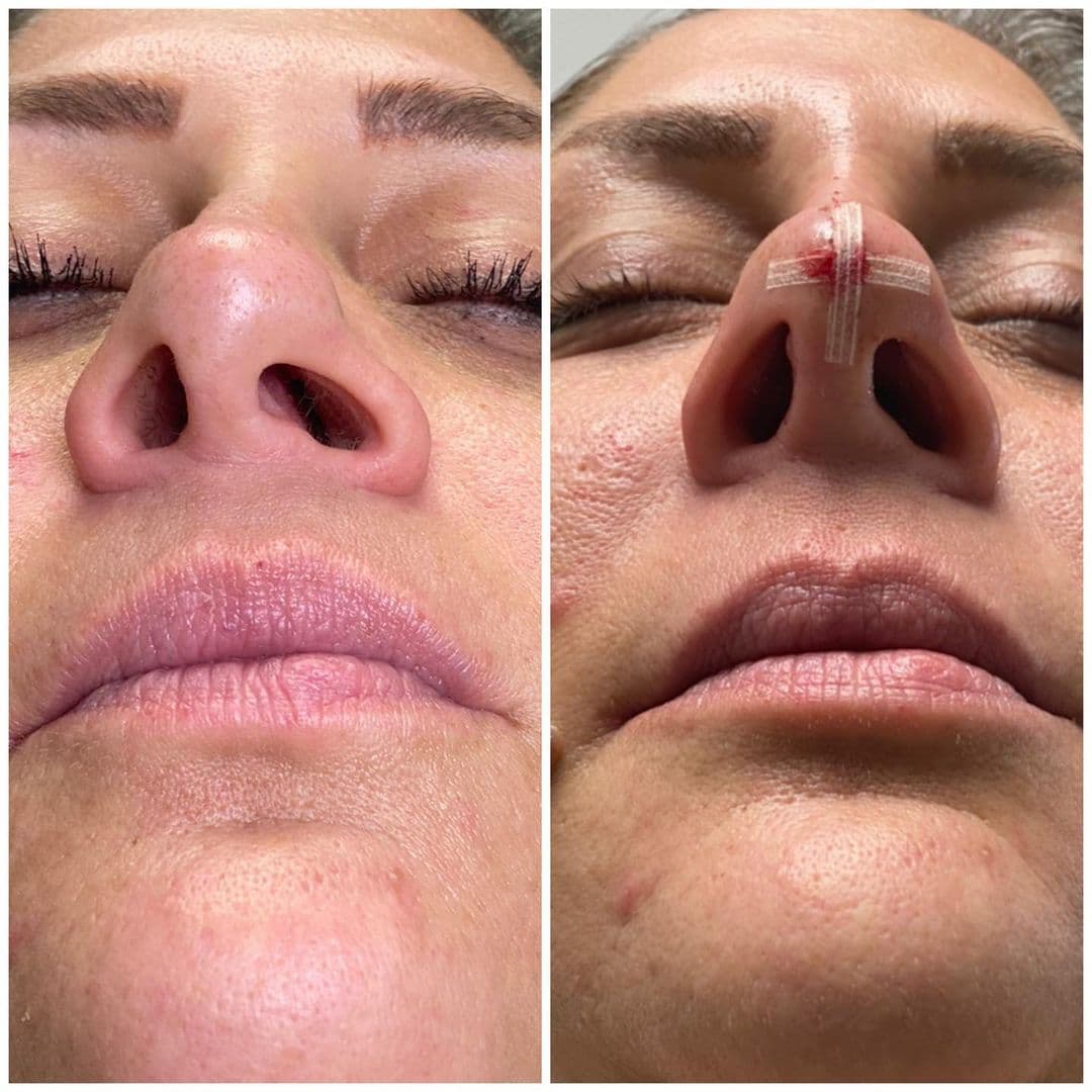 Non-Surgical Nosejob | Aura Medspa — photo 2