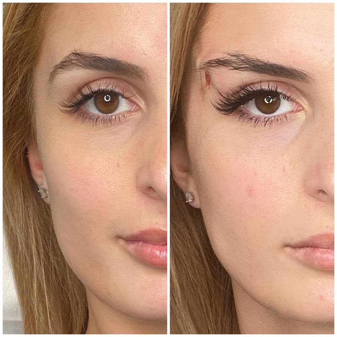 Fox Eyes Thread Lift | Aura Medspa — photo 1