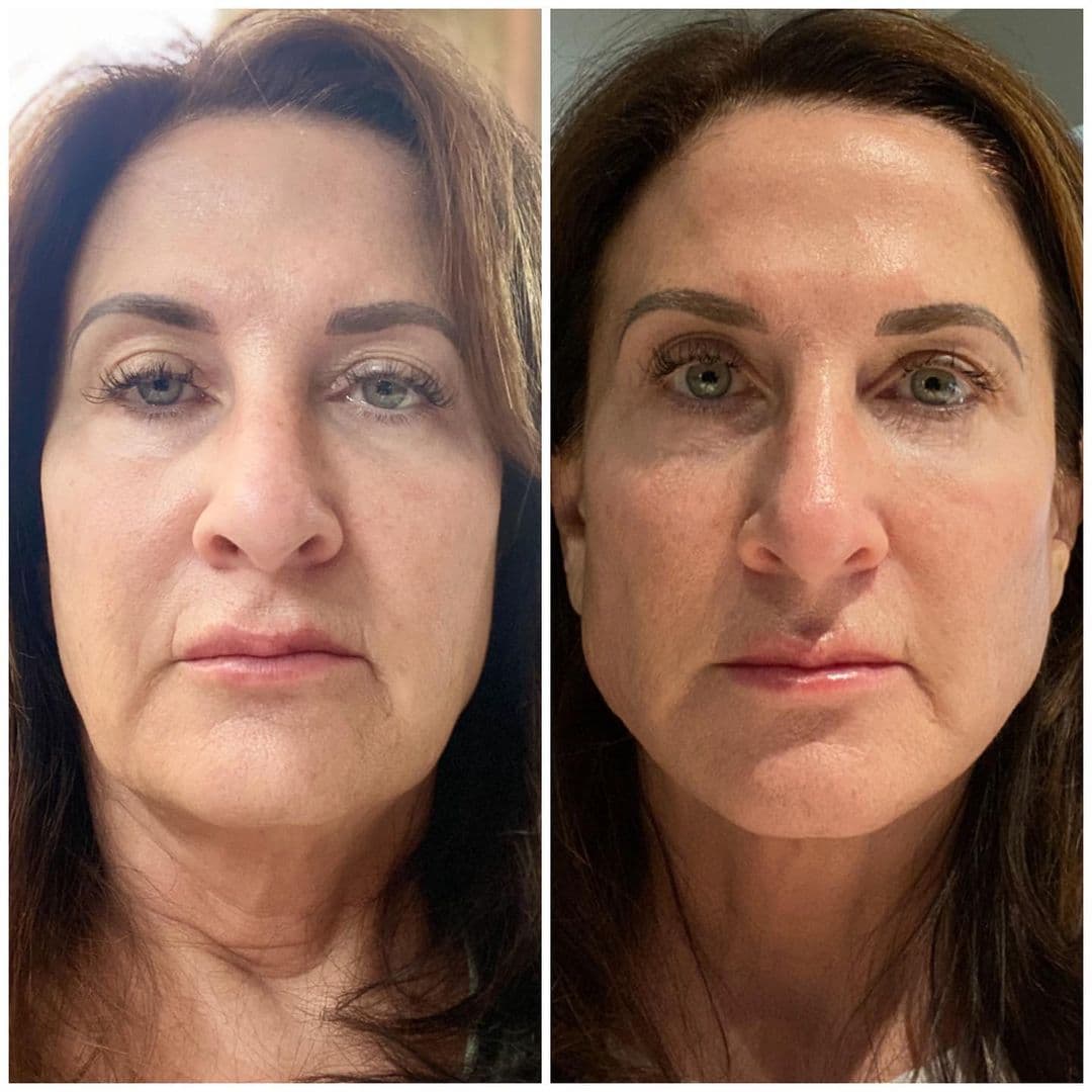 Non-Surgical Facelift | Aura Medspa — photo 1