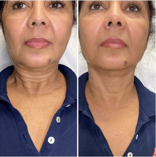 Non-Surgical Necklift | Aura Medspa — photo 1