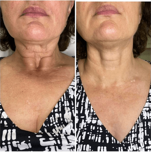 Non-Surgical Necklift | Aura Medspa — photo 2