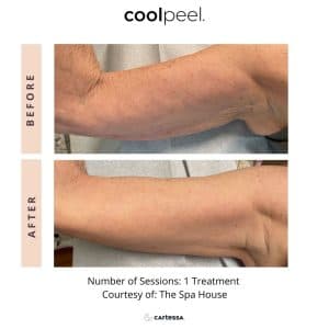 Tetra Pro CoolpeelC02 Laser | Aura Medspa — photo 1