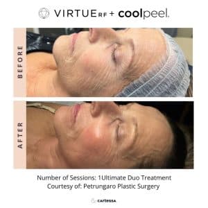 Tetra Pro CoolpeelC02 Laser | Aura Medspa — photo 2