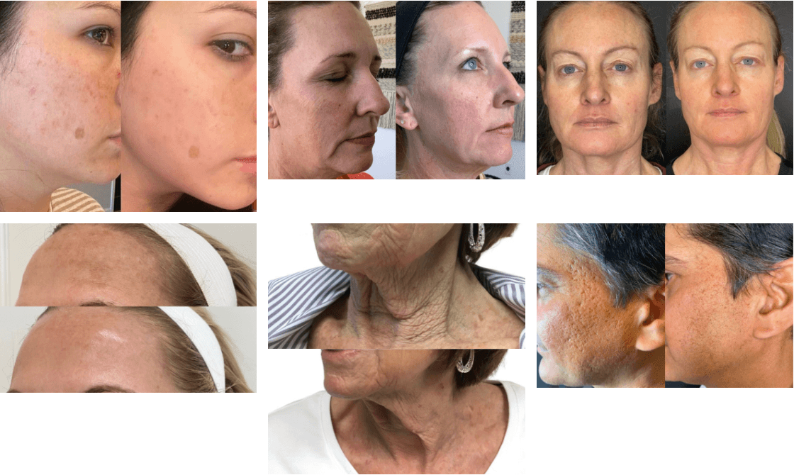 Virtue RF Microneedling in Vienna | Aura Medspa — photo 1